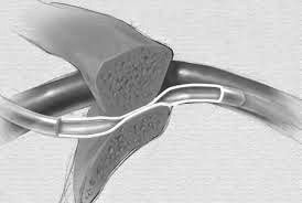 Complicaciones en reservorios: Síndrome de pinch off