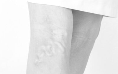 ¿En qué consiste la escleroterapia?