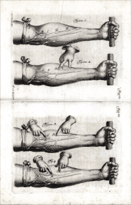 Orígenes de las terapias intravenosas