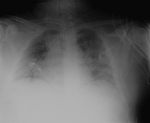 radiologías de tórax shock séptico