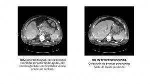 tac a las 72h shock séptico