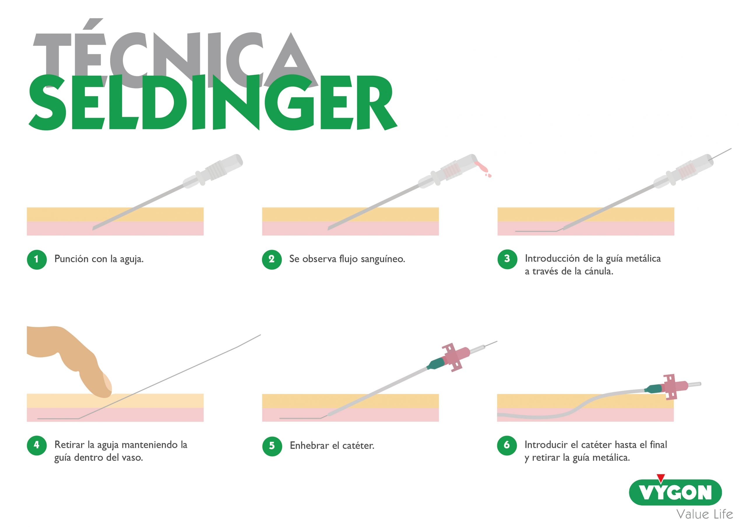 técnica seldinger