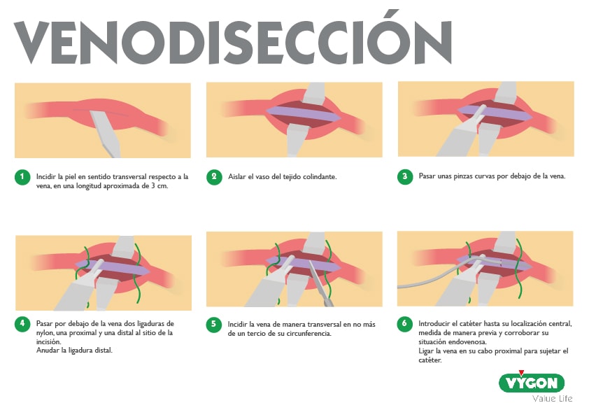 venodisección