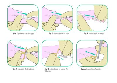 Paso a paso: Introductores para la colocación de catéteres en RN
