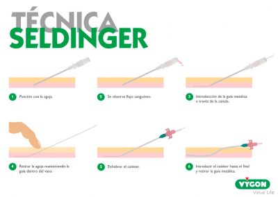 Técnica Seldinger