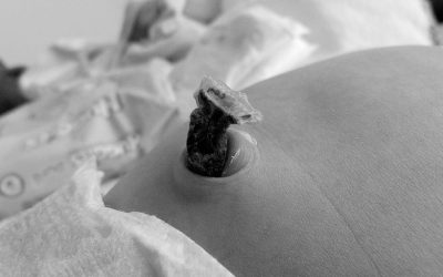 Mantenimiento y observación de catéteres umbilicales