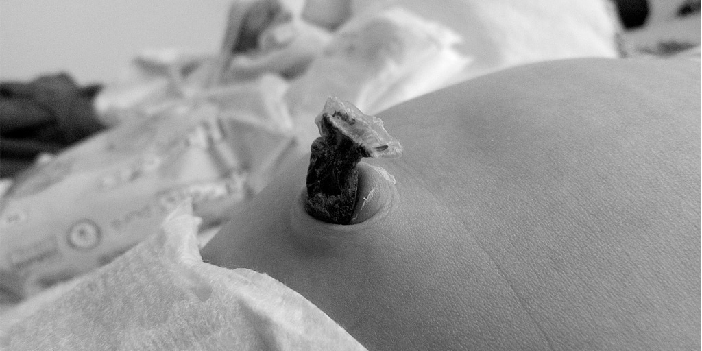 ¿Cuándo está indicado el uso de un catéter umbilical?