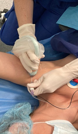 Claves para realizar un buen bloqueo del plexo braquial a nivel axilar