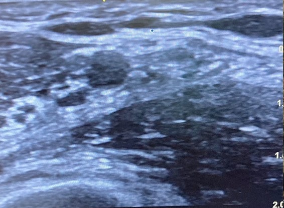 Claves para realizar un buen bloqueo del plexo braquial a nivel axilar