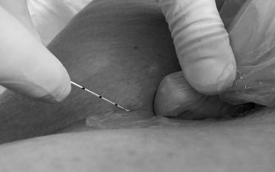 Claves para realizar un buen bloqueo del nervio femoral