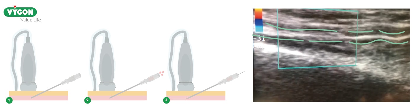 Verificar la correcta posición del fiador en el interior de la arteria radial 