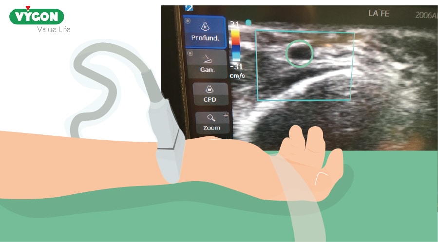 canalización arterial fuera de plano