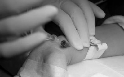 8 Complicaciones que podemos encontrarnos durante la canalización arterial