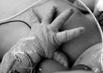 Whitepaper: ¿Por qué la jeringa de bajo volumen (LDT) NO elimina los riesgos de sobredosis en neonatos?