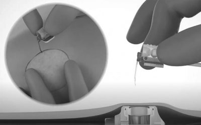 ¿Es correcto usar el clamp para hacer presión positiva al retirar una aguja Huber?