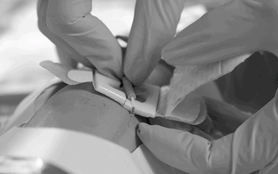 ¿Cómo usar el catéter midline? Protocolo de colocación y mantenimiento