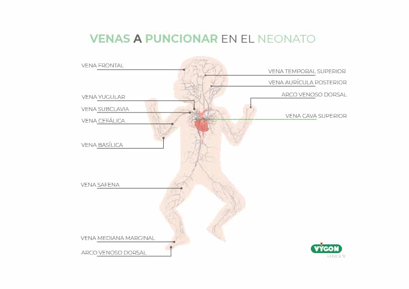 Venas a puncionar en neonatos