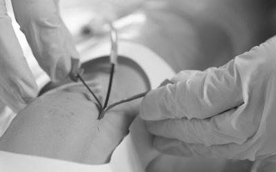 ¿Cómo usar el catéter PICC?: Protocolo de colocación y mantenimiento