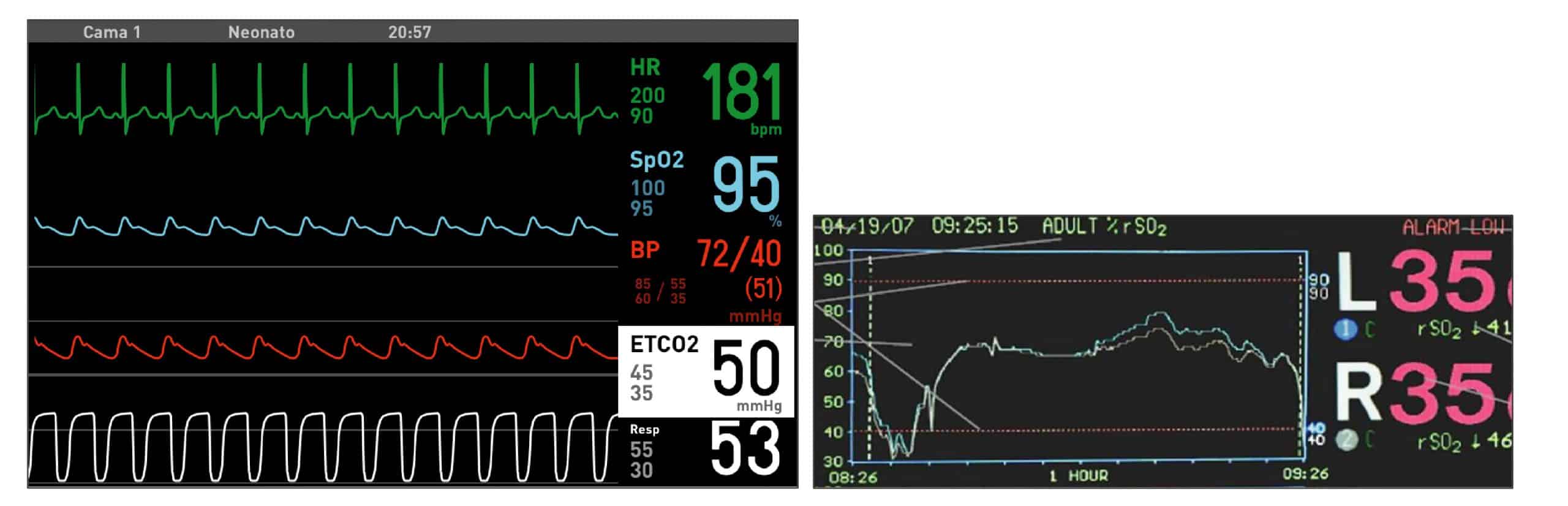 extubación cx cardíaca ped