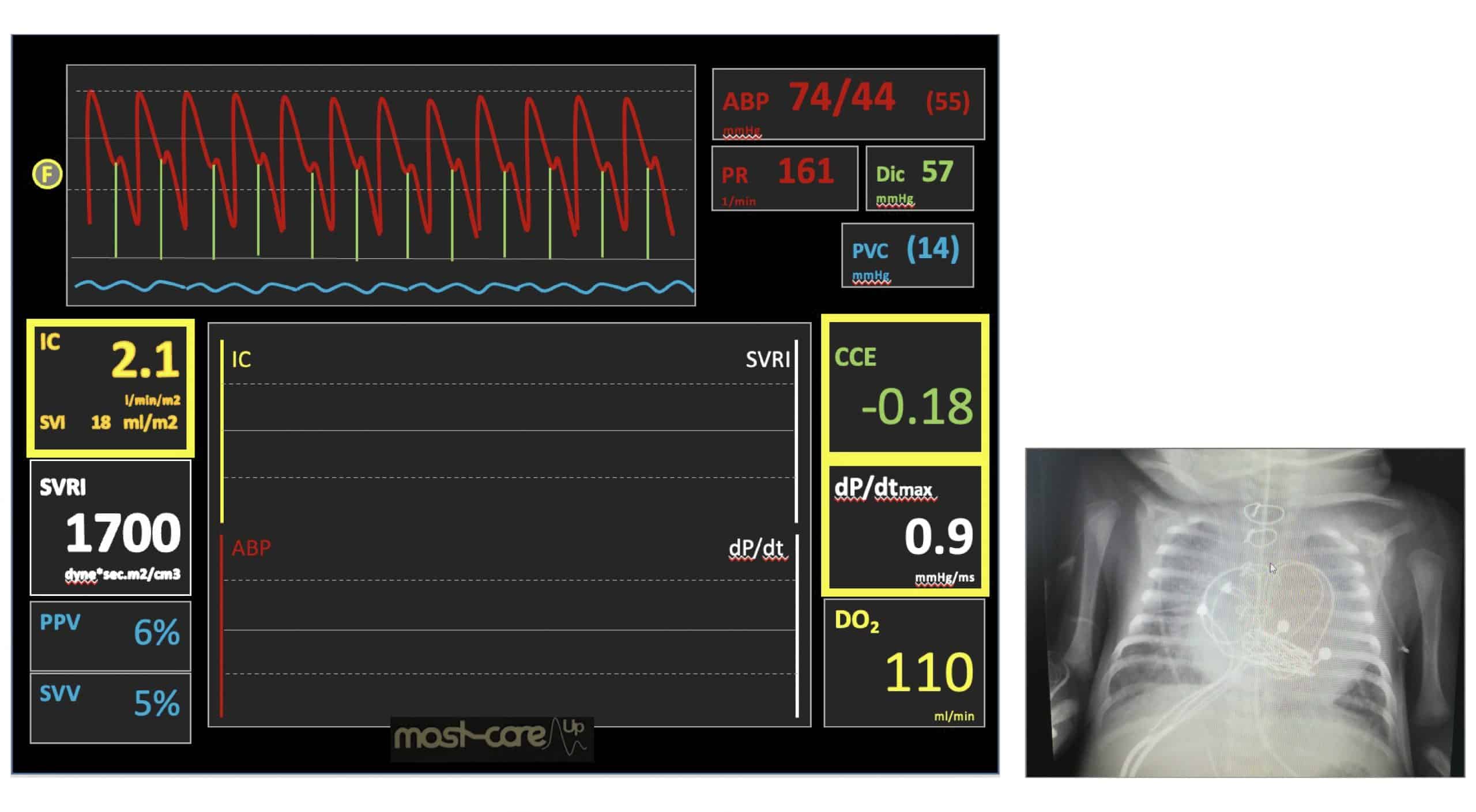 monitorización cx cardíaca ped