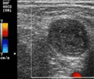 Detección de trombos y hematomas