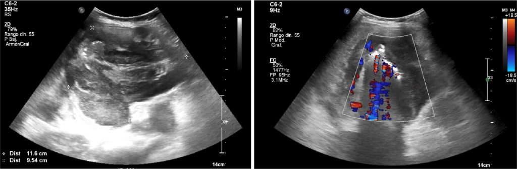 ecografía lisis tumoral