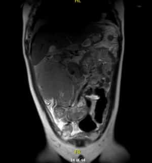 resonancia magnética lisis tumoral