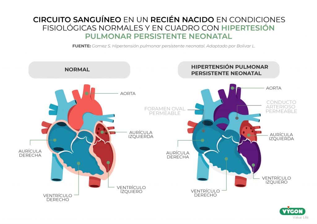 Circuito sanguíneo en un recién nacido en cuadro con hipertensión pulmonar persistente neonatal