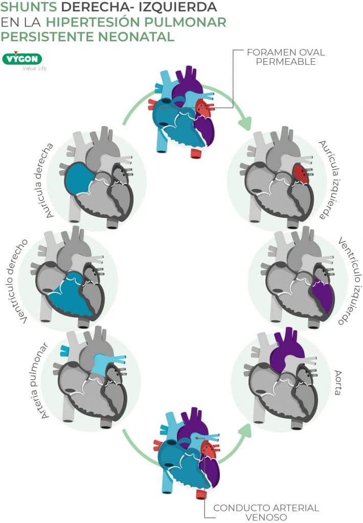 Shunts derecha-izquierda HPPN