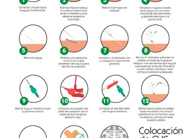 Colocación de CVC guiada por ECG