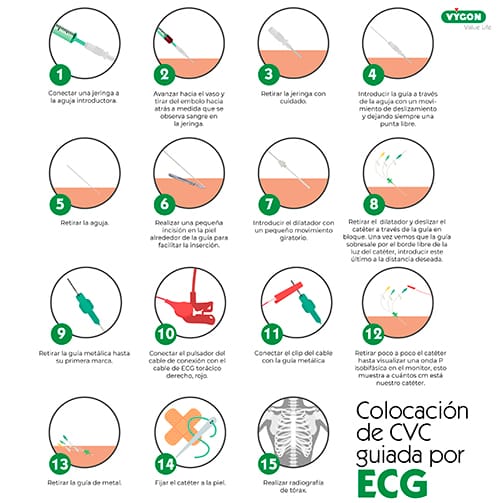 colocación cvc por ecg