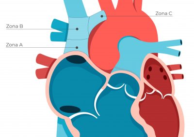 Áreas de importancia para la colocación de CVC