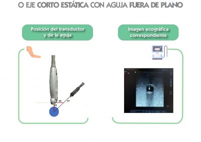 Técnica ecográfica estática en plano transversal