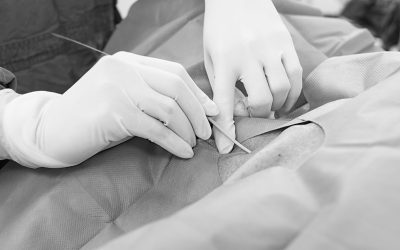 ¿Cuál es la longitud ideal para mi catéter venoso central?