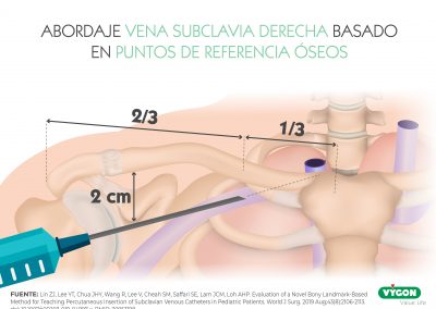 Abordaje vena subclavia derecha basado en puntos de referencia óseos