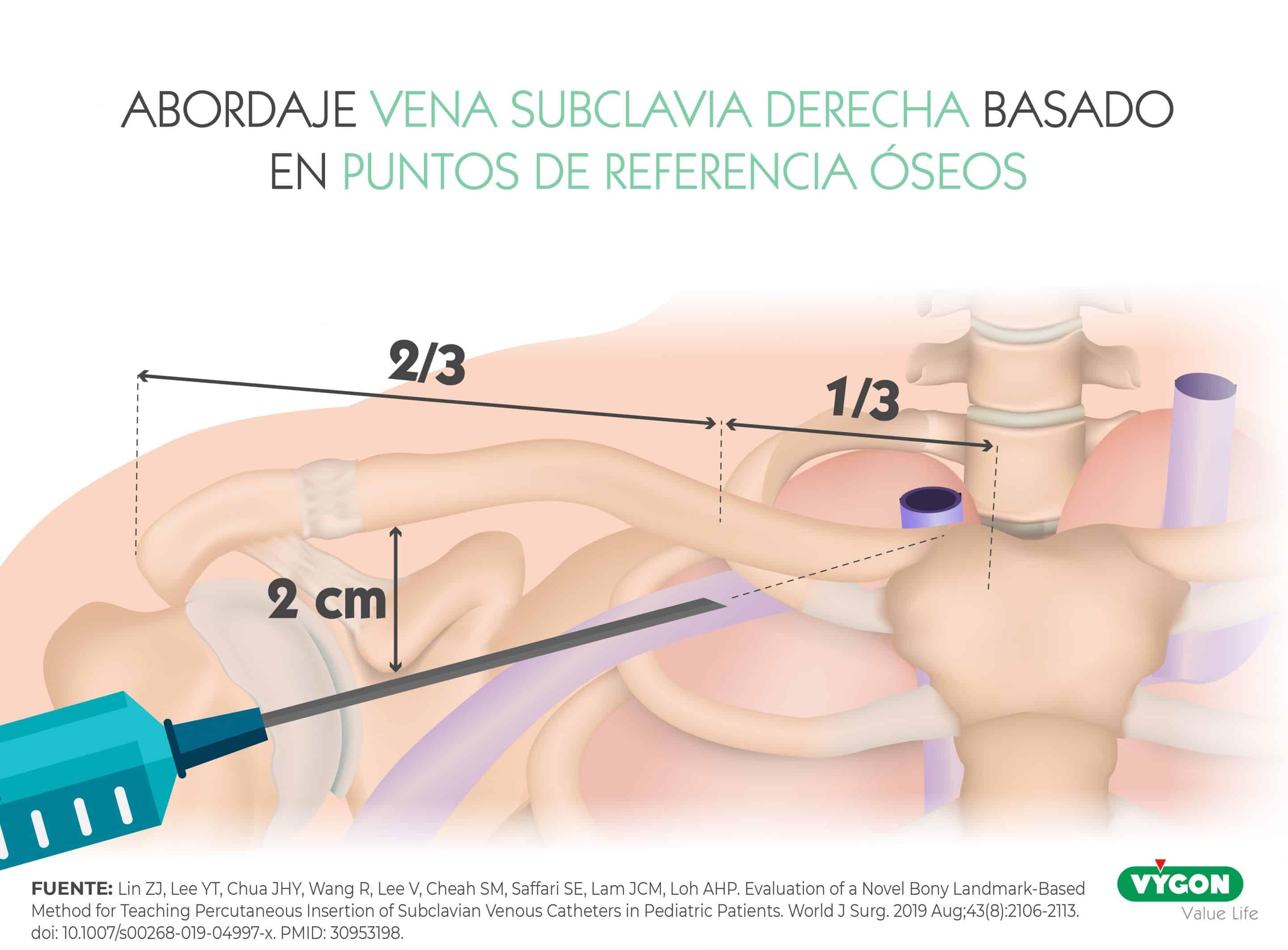 abordaje vena subclavia derecha en función de puntos de referencia óseos