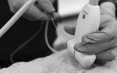 Las claves para realizar un bloqueo del plexo sacro: Bloqueo del nervio ciático