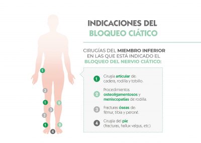 Cirugías del miembro inferior en las que está indicado el bloqueo del nervio ciático.