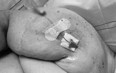 Cuándo y cómo y usar la fijación con anclaje subcutáneo