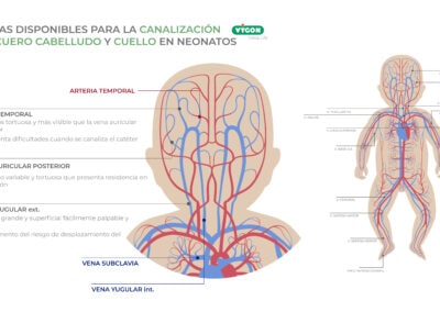Venas disponibles para la canalización en cuero cabelludo y cuello en neonatos