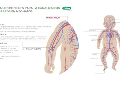 Venas disponibles para la canalización en brazos en neonatos