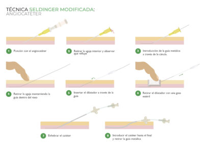 Canalización del PICC neonatal con Técnica Seldinger Modificada: Angiocatéter