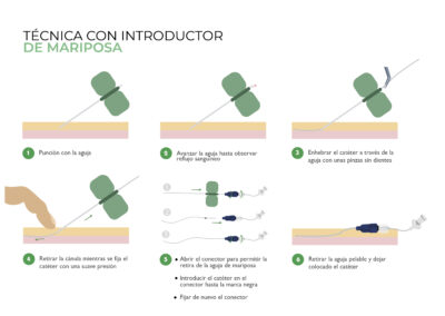 Técnica de punción para canalización con aguja mariposa