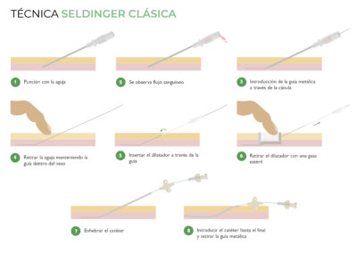 Canalización de PICC neonatal con Técnica Seldinger Clásica
