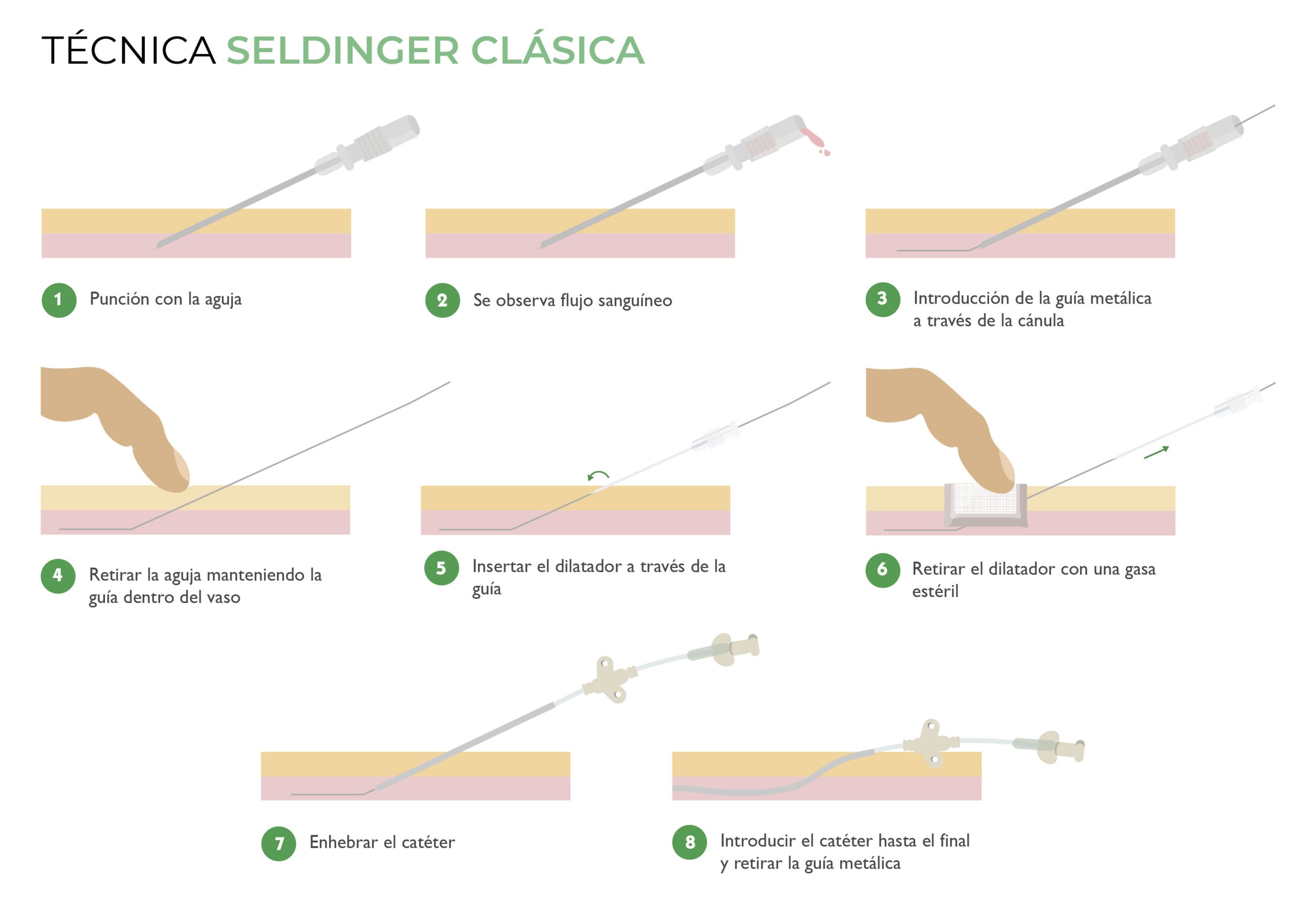 PICC neonatal técnica seldinger clásica