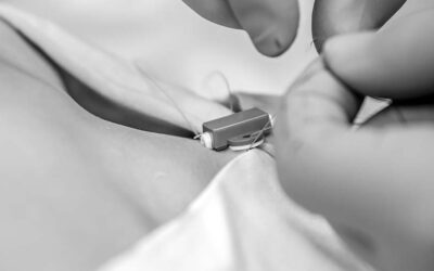 13 claves para evitar complicaciones asociadas a la canalización de la vena subclavia