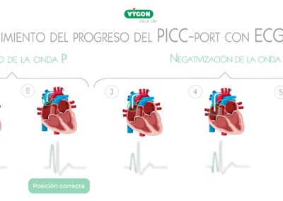 Seguimiento del progreso de un PICC-port con ECG-IC