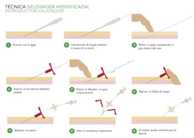 Canalización PICC neonatal con Técnica Seldinger modificada: cánula pelable
