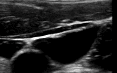 ¿POR QUÉ UTILIZAR LA ECOGRAFÍA EN LA CANALIZACIÓN VENOSA CENTRAL?