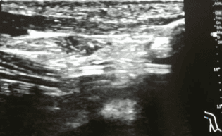 VENTAJAS DEL USO DE LA ECOGRAFÍA APLICADA A LA TÉCNICA MICROSELDINGER EN EL PACIENTE NEONATAL